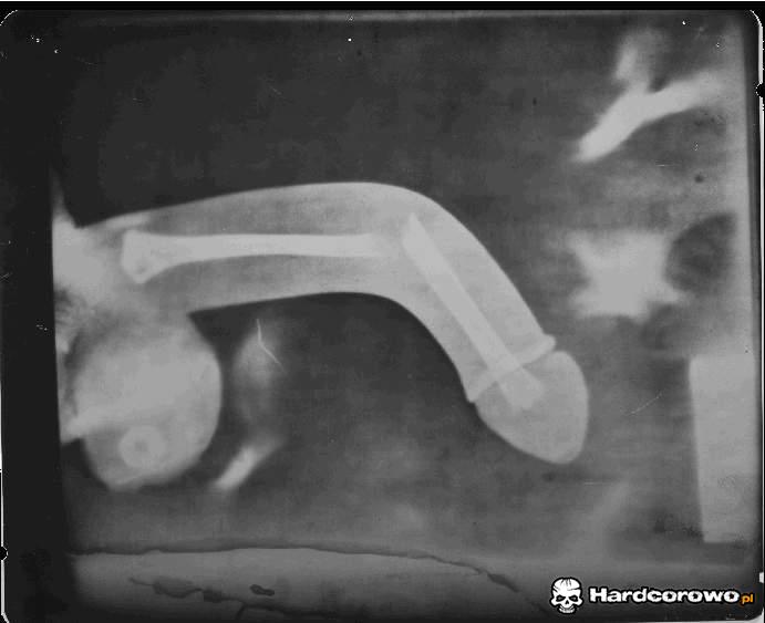 Złamany penis - 1